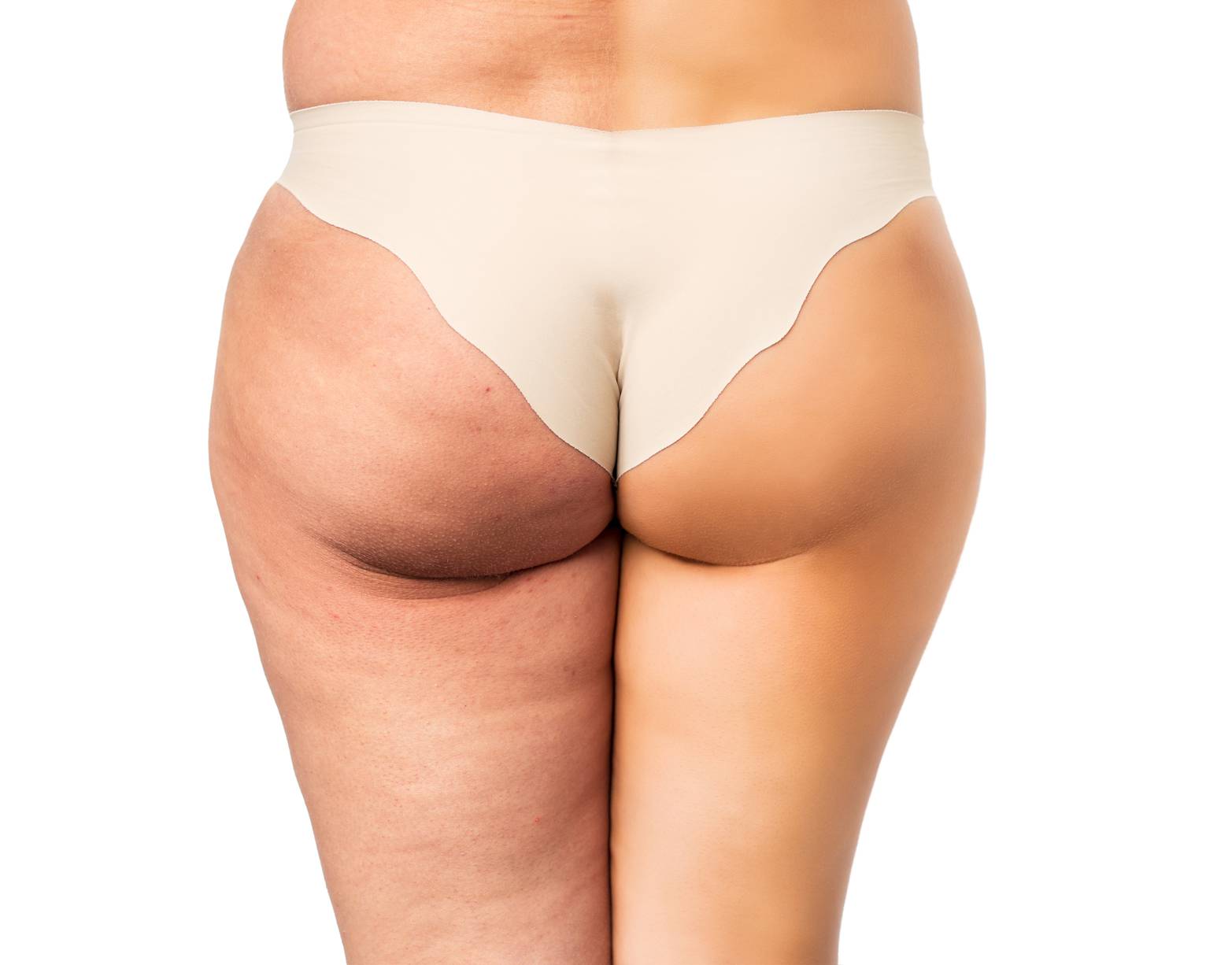 sconfiggere la cellulite