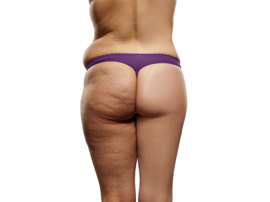 female body before and after liposuction