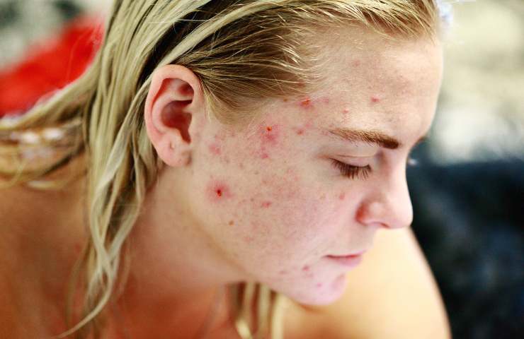 come combatter l'acne